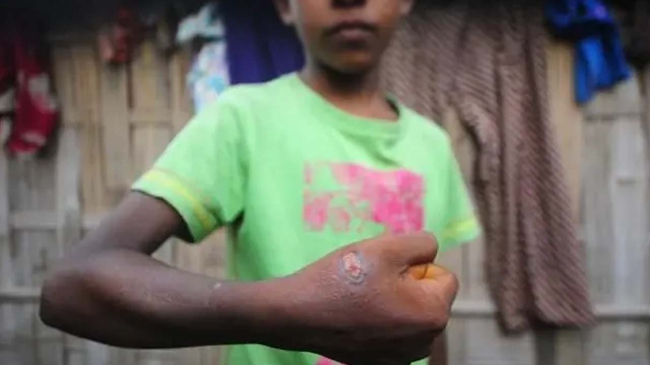 অ্যানথ্রাক্স আক্রান্ত একজন কিশোর। ছবি: বিবিসি বাংলা থেকে নেওয়া