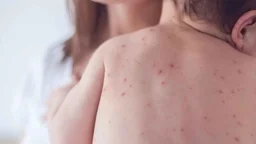 হাম ও উপসর্গে মৃত্যু হাজার ছুঁই ছুঁই