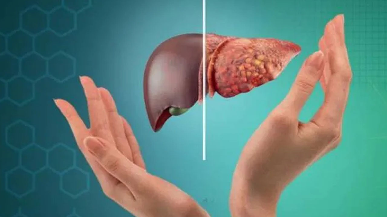 fatty liver 3