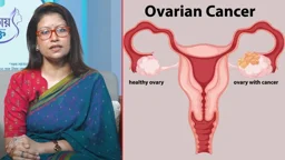 নারীদের নীরব ঘাতক ওভারিয়ান ক্যানসার, সতর্কতামূলক পরামর্শ ডা. নুসরাতের