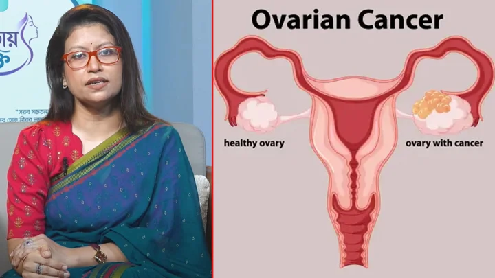 নারীদের নীরব ঘাতক ওভারিয়ান ক্যানসার, সতর্কতামূলক পরামর্শ ডা. নুসরাতের