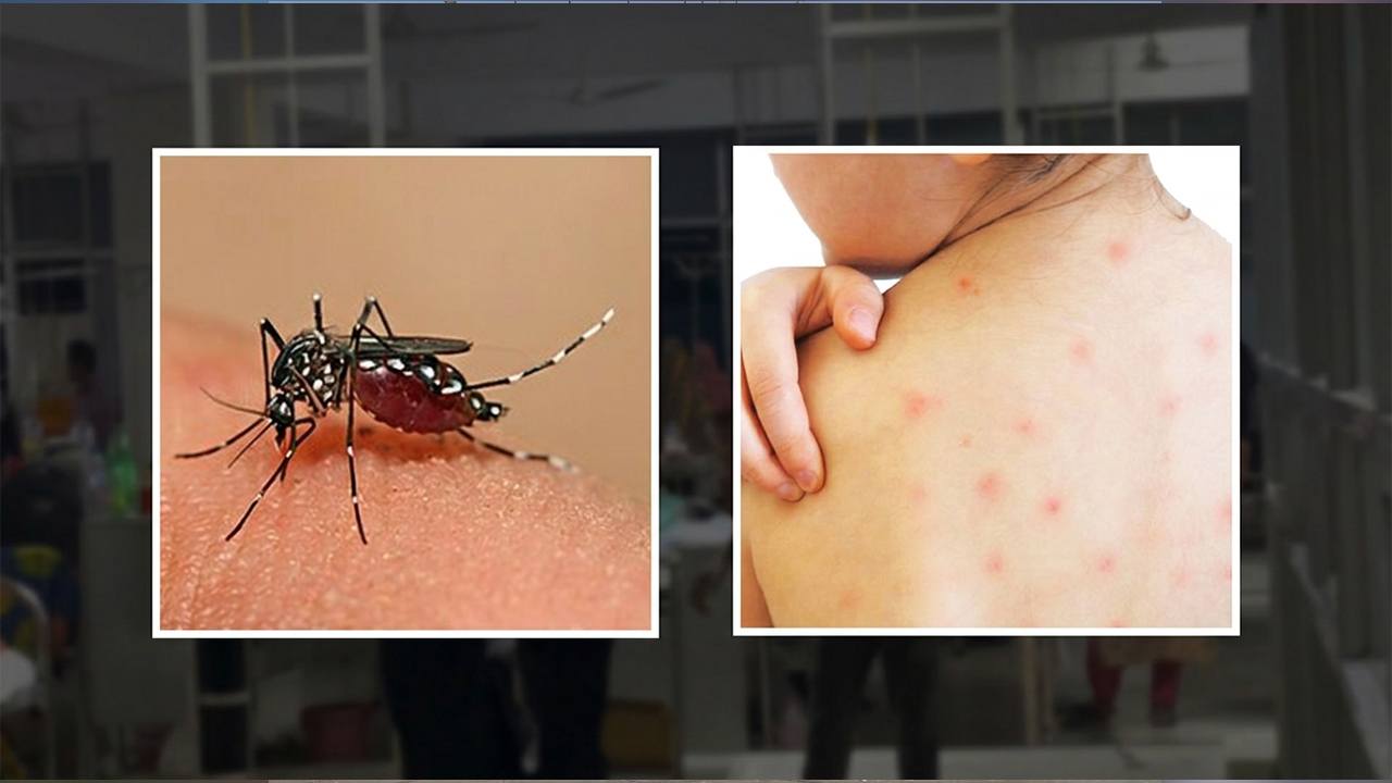 dengue-measels