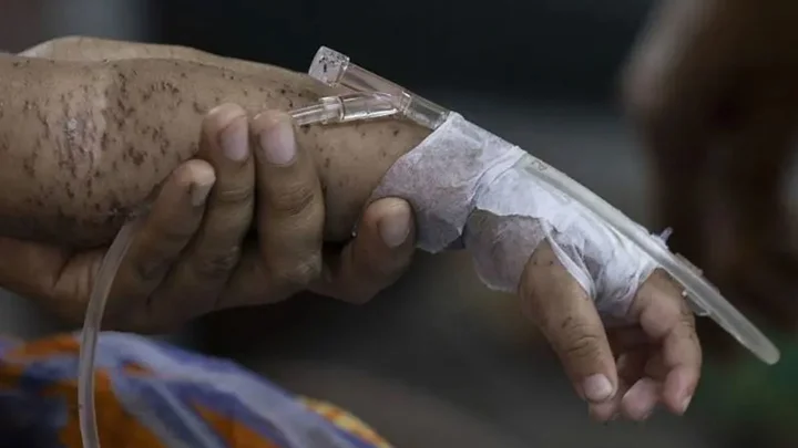 ২৪ ঘণ্টায় হামের উপসর্গে আরও ৪ শিশুর মৃত্যু