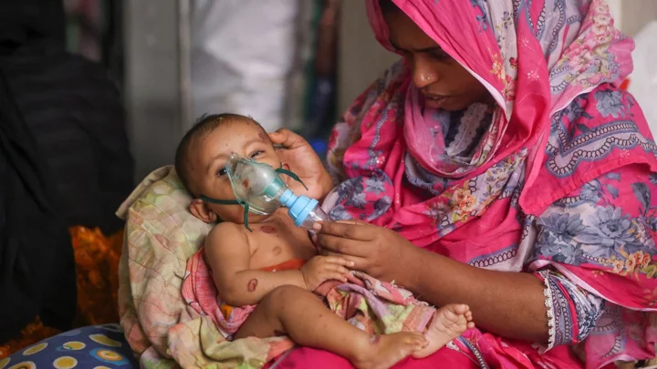 হামের ভয়াবহ রূপ কেমন হতে পারে, তা দেখাচ্ছে বাংলাদেশ