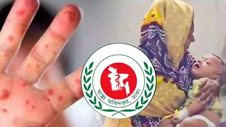 দেশে এক দিনে হাম উপসর্গে আরও ৩ শিশুর মৃত্যু
