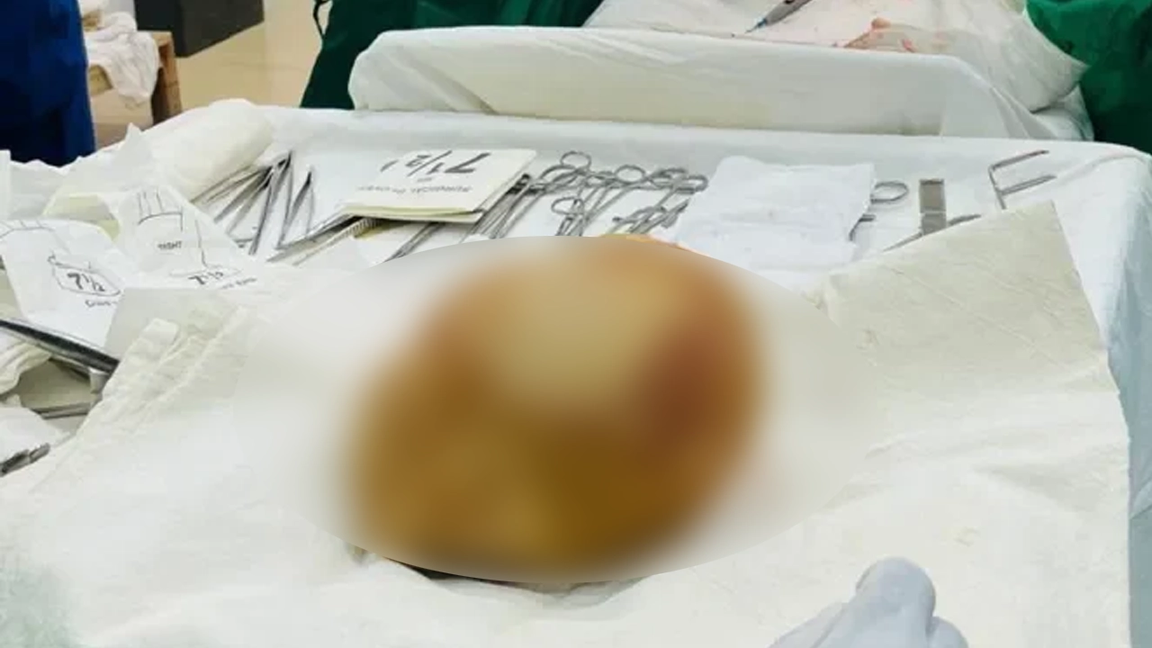 মূত্রথলি থেকে বের হলো ‘দানবাকৃতির’ পাথর
